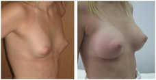 Powiększanie piersi implantami przed i po zabiegu