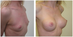 Powiększanie piersi przed i po zabiegu