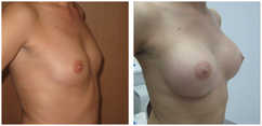 Powiększanie piersi przed i po zabiegu