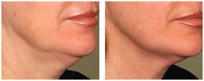 Ulthera - lifting podbródka i szyi przed i po zabiegu