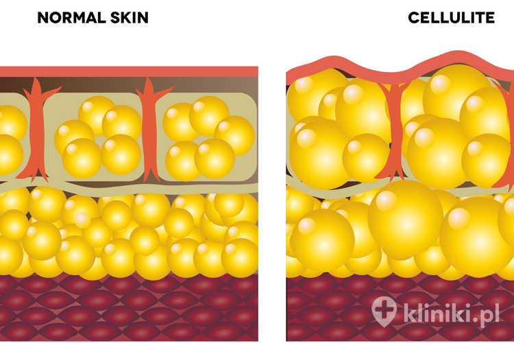 Usuwanie celulitu laserem Cellulaze - skóra przed i po zabiegu