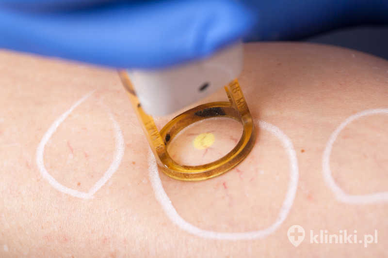 Zamykanie naczynek laserem polega na wykorzystaniu energii światła pochłanianej przez hemoglobinę