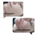Peelingi medyczne - odmładzanie i rewitalizacja skóry przed i po zabiegu