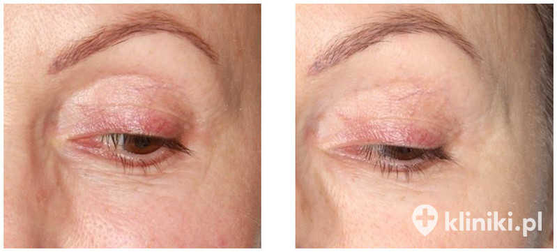 Przeszczep tłuszczu w okolice doliny łez pozwala wypełnić ubytki objętości i rozjaśnić zasinienia pod oczami Przeszczep tłuszczu w okolice doliny łez pozwala wypełnić ubytki objętości i rozjaśnić zasinienia pod oczami