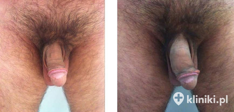 Chcesz zobaczyć jak wygląda penis po zabiegu powiększania? 