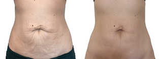 Liposukcja - odsysanie tłuszczu przed i po zabiegu