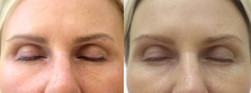 Makijaż permanentny - usuwanie laserem przed i po zabiegu
