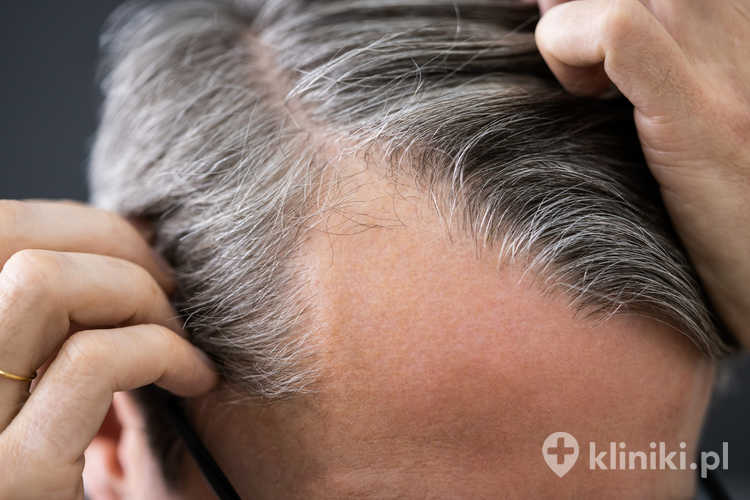 Biofibre umożliwia natychmiastowe zagęszczenie włosów bez konieczności przeszczepu mieszków włosowych