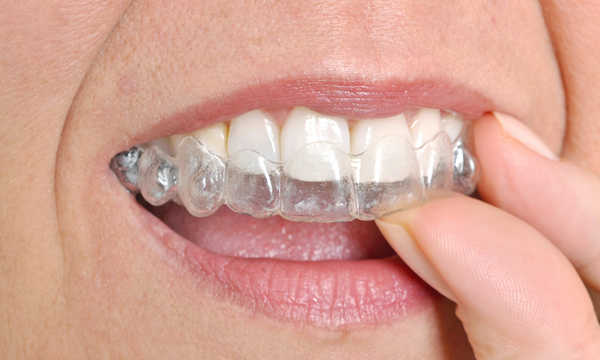 Aparat ortodontyczny Clear Aligner