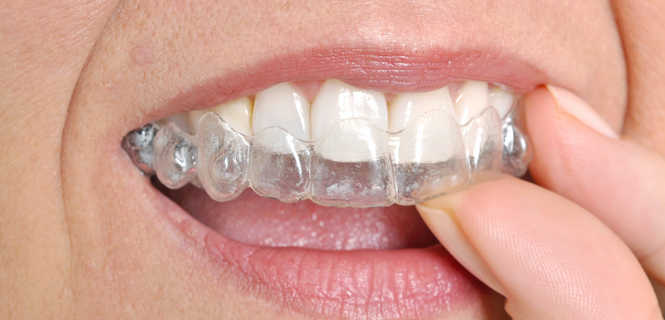 Aparat ortodontyczny Clear Aligner