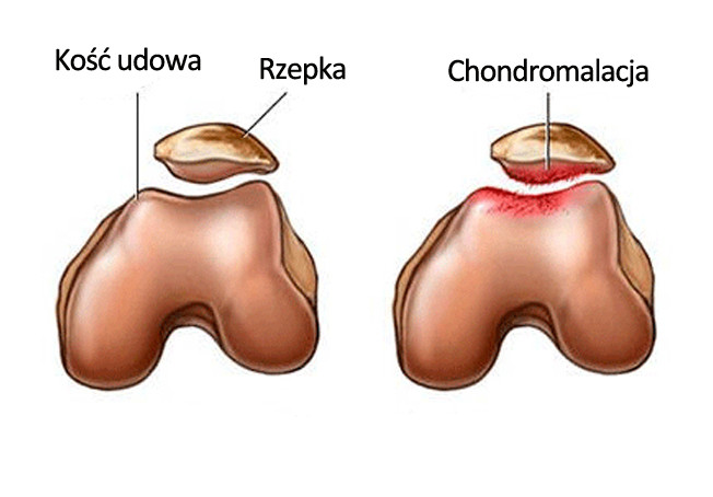 Chondromalacja rzepki - rysunek poglądowy