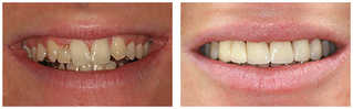 Protetyka stomatologiczna przed i po zabiegu
