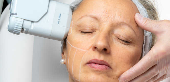Laserowy resurfacing skóry