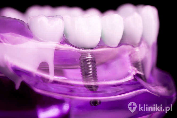 wszczepienie implantów zębowych