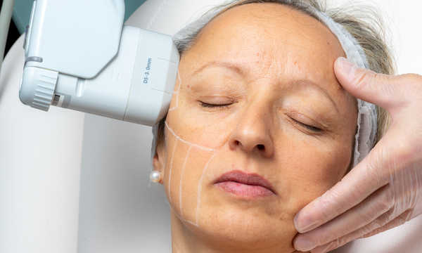 Zabieg liftingu twarzy za pomocą lasera