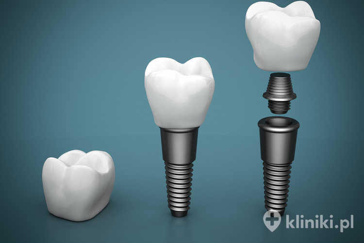 Implant zęba