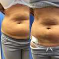 Liposukcja brzucha przed i po zabiegu