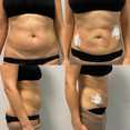 Liposukcja klasyczna SAL przed i po zabiegu