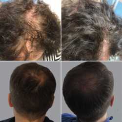 Leczenie łysienia- zabieg DR. CYJ HAIR FILLER przed i po zabiegu