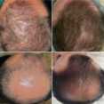 Leczenie łysienia- zabieg DR. CYJ HAIR FILLER przed i po zabiegu