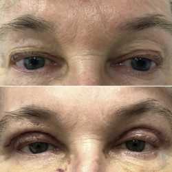 Blefaroplastyka