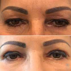 Blefaroplastyka