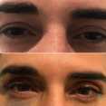 Blefaroplastyka