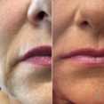 Podniesienie kącików ust wypełniaczem przed i po zabiegu