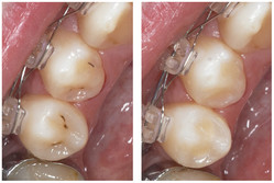 Minimalnie inwazyjne opracowanie próchnicy w bruzdach zębów przedtrzonowych (4 i 5) wraz z wypełnieniem nanocząsteczkowym kompozytem