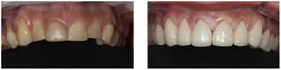Periodontologia przed i po zabiegu