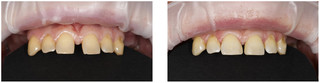 Stomatologia zachowawcza przed i po zabiegu
