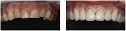 Wydłużenie korony klinicznej zęba przed i po zabiegu