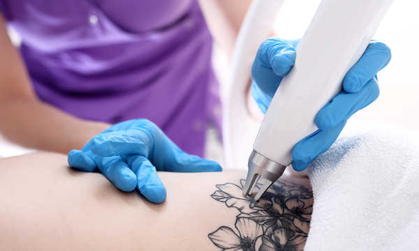 Laserowe usuwanie tatuaży polega na rozbijaniu pigmentu za pomocą impulsów światła Laserowe usuwanie tatuaży polega na rozbijaniu pigmentu za pomocą impulsów światła