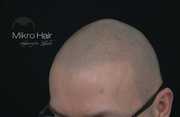 Zabiegi mikropigmentacji włosów przed i po zabiegu