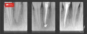 leczenie wykonane pod mikroskopem daje możliwość regeneracji kości i utrzymania zęba na długie lata