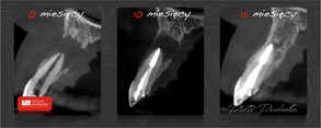 piękna regeneracja kości po endodoncji wykonanej na jednej wizycie pod mikroskopem całkowicie bezboleśnie