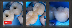 estetyczne zamknięcie przykręcanych koron na implantach - mistrzowski poziom pracy naszych lekarzy