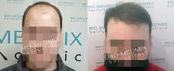MD Medmix hair clinic, Bielsko-Biała - opinie i cennik 2025