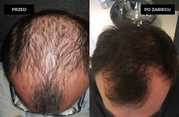 Przeszczep włosów FUE u mężczyzn przed i po zabiegu