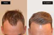 Przeszczep włosów FUE u mężczyzn przed i po zabiegu