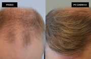 Przeszczep włosów FUE u mężczyzn przed i po zabiegu