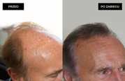 Przeszczep włosów FUE u mężczyzn przed i po zabiegu