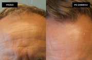 Zabiegi przeszczepiania włosów przed i po zabiegu