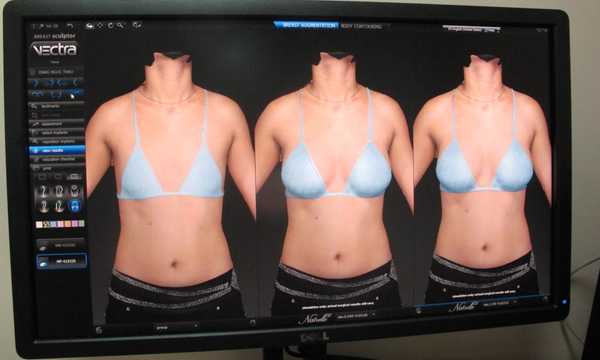Komputerowa wizualizacja 3D powiększenia piersi implantami