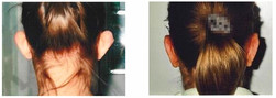 Operacje plastyczne uszu przed i po zabiegu