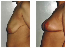 Podniesienie piersi przed i po zabiegu