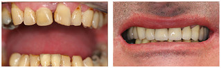Protetyka stomatologiczna przed i po zabiegu