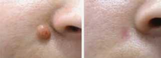 Dermatochirurgia przed i po zabiegu