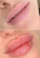 Powiększanie ust kwasem hialuronowym przed i po zabiegu