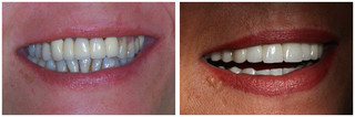Aparat ortodontyczny przed i po zabiegu